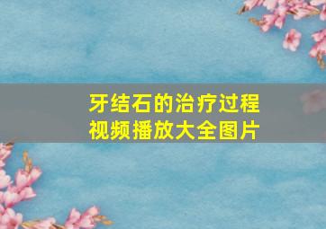 牙结石的治疗过程视频播放大全图片